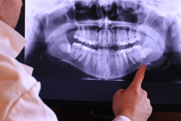 Best Broken Tooth Emergency  in Mirrormont, WA